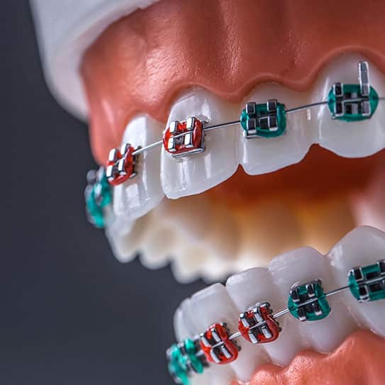 Metal Braces