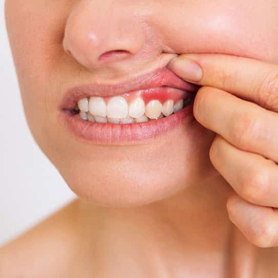 Periodontal Cleanings