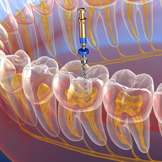 root canal