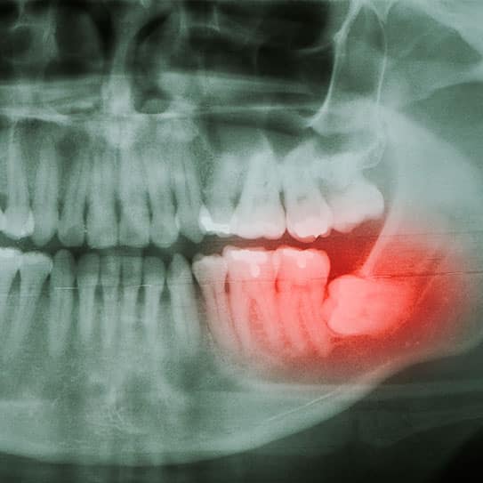wisdom teeth removal
