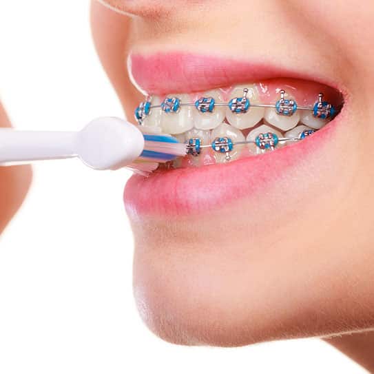 braces