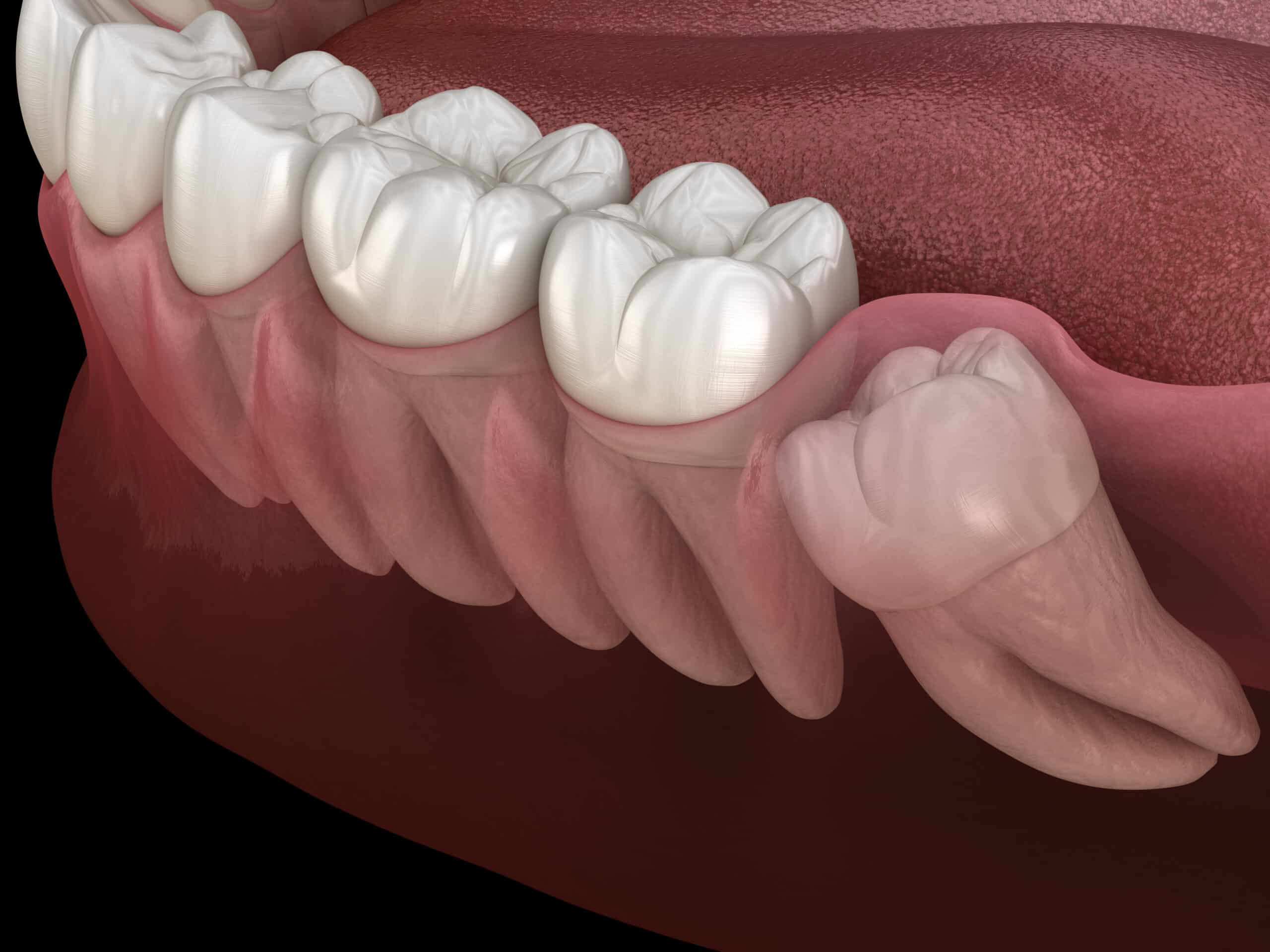 wisdom teeth removal near me