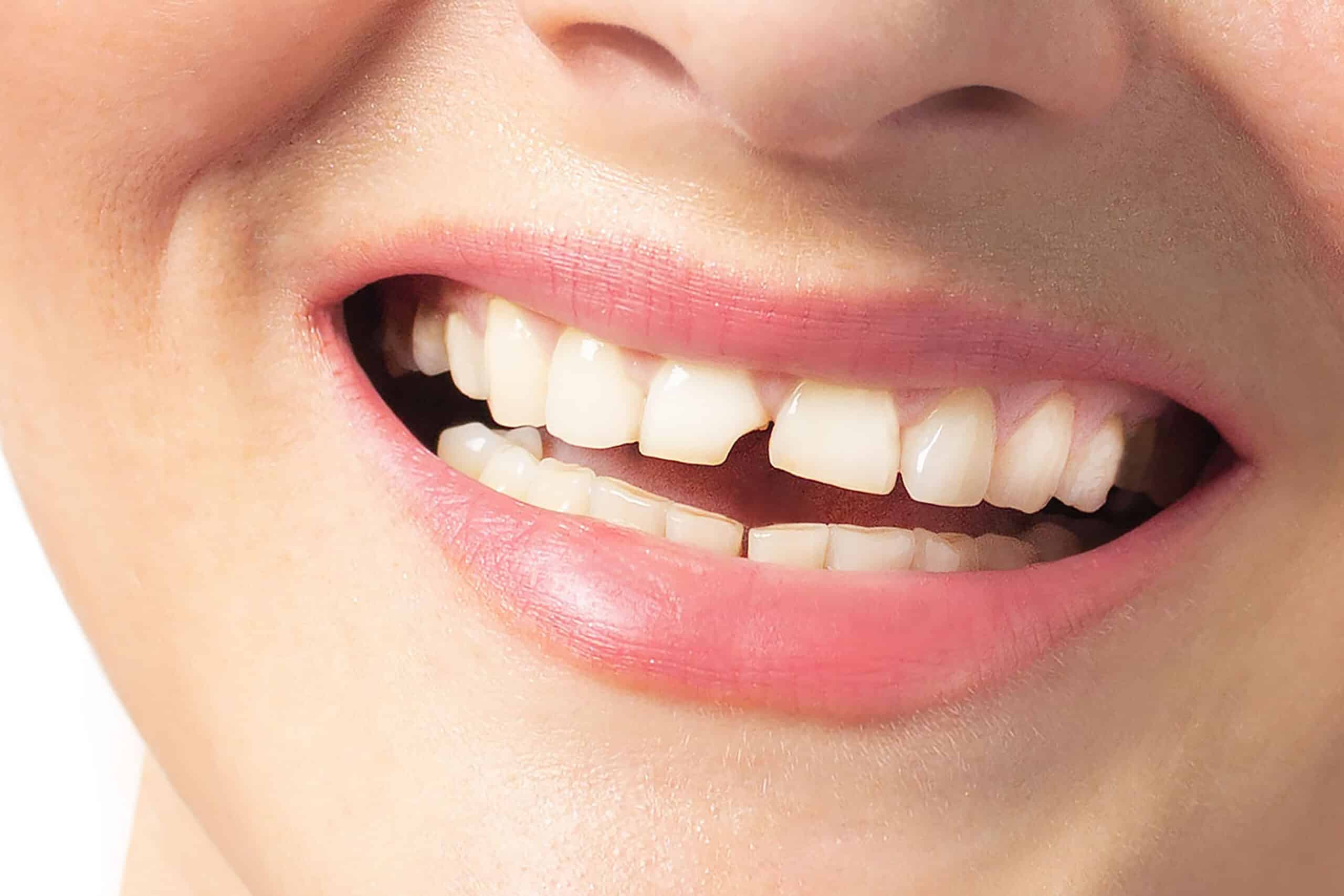 broken tooth same-day dentist San Antonio